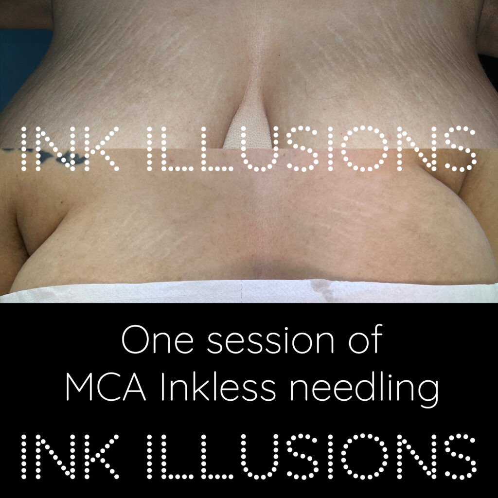 breasts stretch marks treatment in London with serum and needling