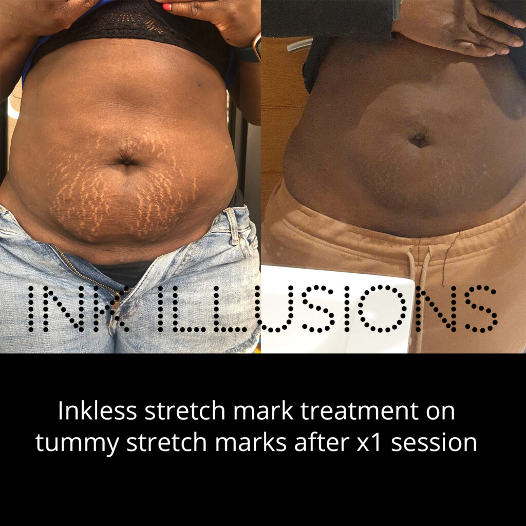 best tummy stretch mark treatment